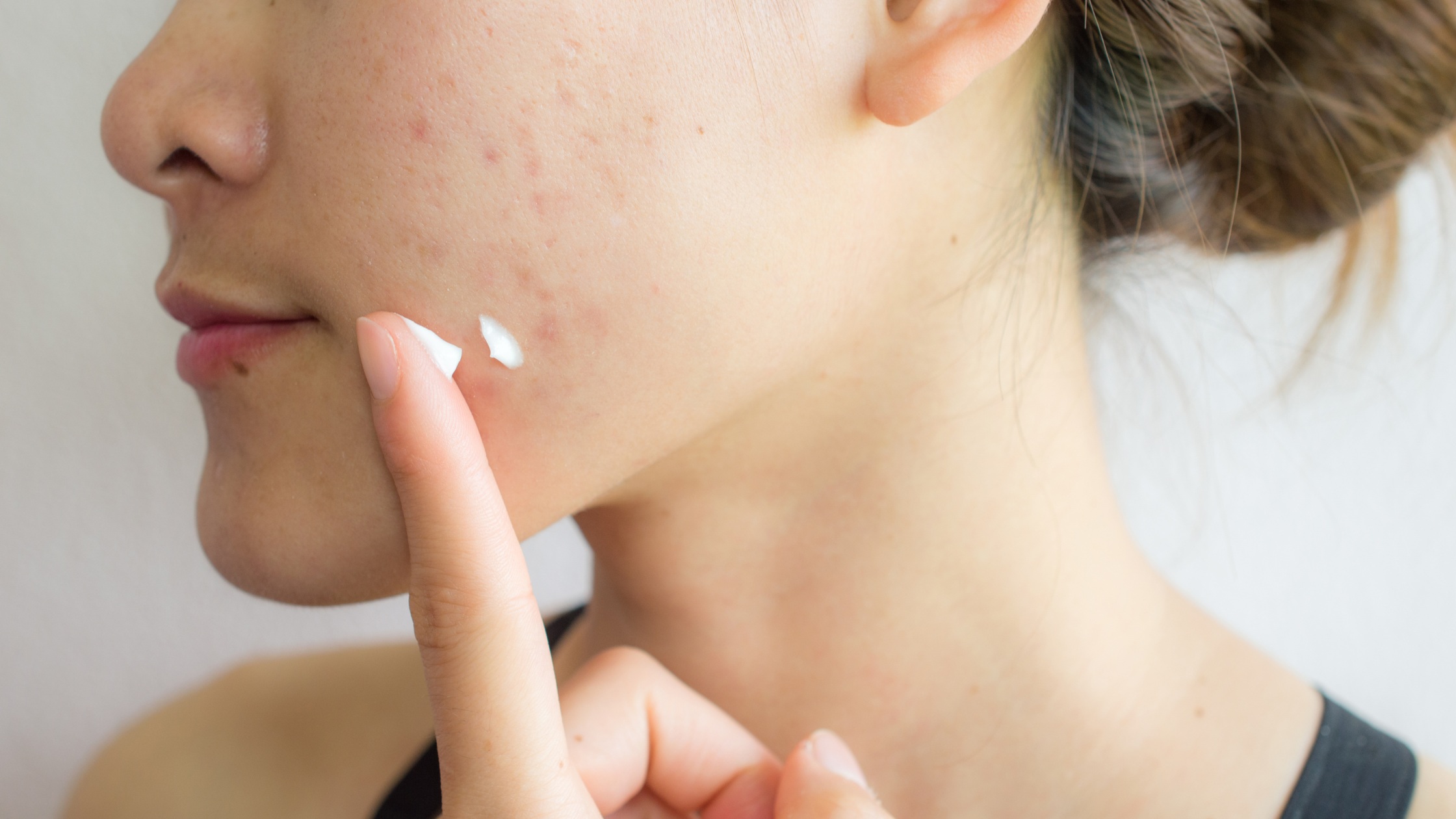 best products for cystic acne